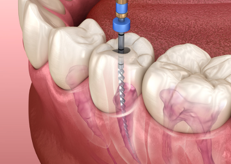 Root Canal Treatment in Flint, MI: Everything You Need to Knowv